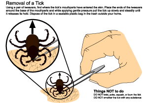 Recommended procedure for removal of an attached tick